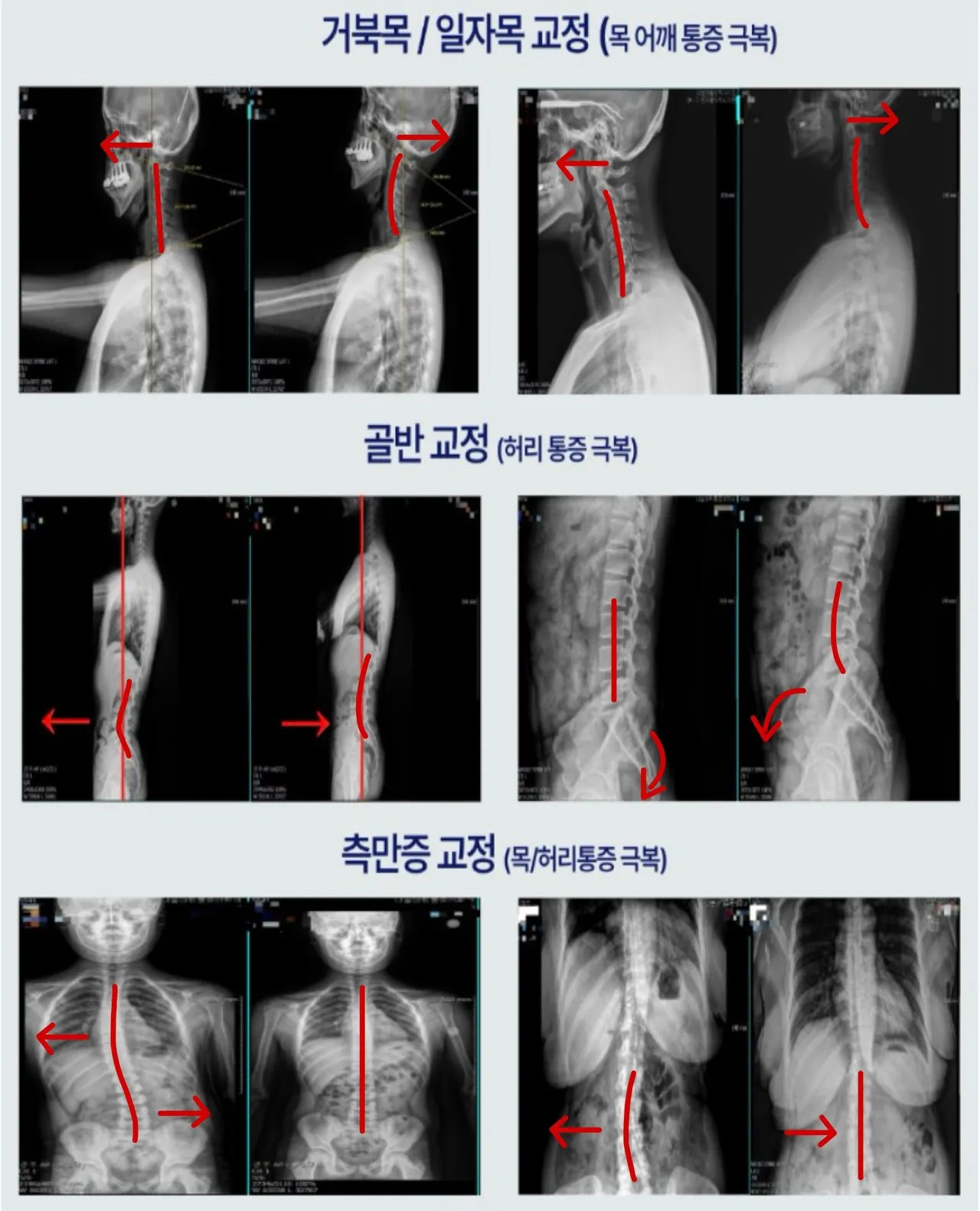 정렬 회복과 운동의 순서를 설명하는 이미지
